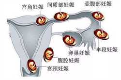 广州借卵生育，孕妇可以做脚底按摩吗
